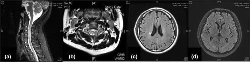 A multi-panel figure displaying diagnostic MRI scans related to central nervous system complications of nitrous oxide abuse, primarily illustrating subacute combined degeneration (SCD) of the spinal cord and cerebral changes. Panel (a) is a sagittal T2-weighted MRI of the cervical spine showing a continuous linear hyperintense signal within the posterior aspect of the spinal cord. Panel (b) shows an axial T2-weighted section of the cervical spinal cord demonstrating the classic 'inverted V sign' (also known as the rabbit ear sign), representing symmetric hyperintensity in the posterior columns (funiculus gracilis and cuneatus). Panel (c) is an axial T2-FLAIR brain MRI showing a focal hyperintense signal in the right corona radiata. Panel (d) is an axial T2-FLAIR brain MRI illustrating generalized cerebral atrophy, characterized by widened cortical sulci and enlarged lateral ventricles. These findings are characteristic of vitamin B12 deficiency-induced myelopathy and encephalopathy, often seen in the clinical context of chronic nitrous oxide exposure.