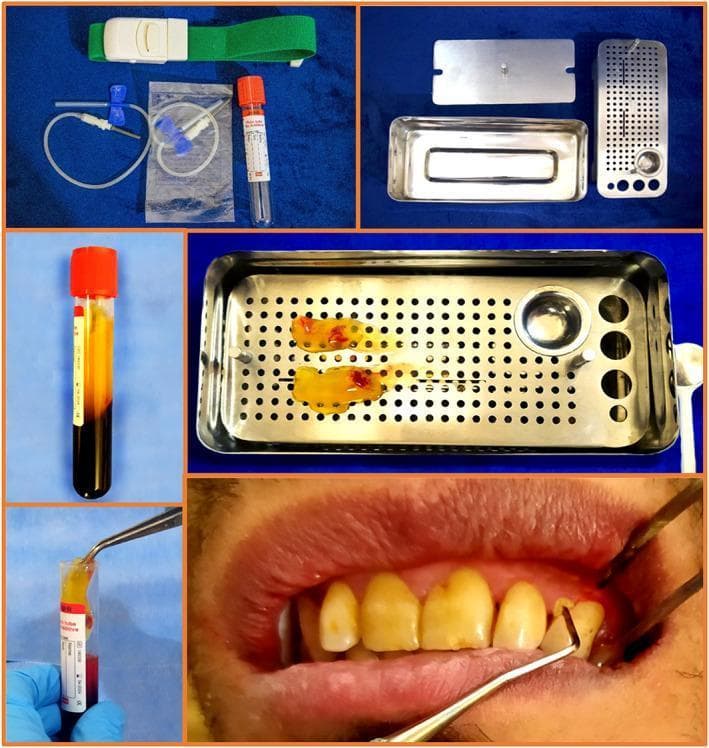 This composite of clinical photographs and diagnostic images details the workflow for Platelet-Rich Fibrin (PRF) preparation and its application in periodontology. The process begins with blood collection equipment, including a green tourniquet, butterfly needle with tubing, and a vacuum collection tube with an orange cap. Post-centrifugation, the blood tube demonstrates distinct layering: an upper clear yellow plasma layer, a middle PRF clot, and a bottom red blood cell mass. A technician is shown using sterile tweezers to extract the yellowish fibrin clot. The central panel illustrates processed PRF membranes resting on a perforated stainless steel PRF box used for compression. The final clinical photograph depicts the intraoral application, where a dental probe is used to place the PRF clot into a 4-6 mm periodontal pocket in a patient with periodontitis. The image demonstrates the transition from biological sample collection to a regenerative surgical adjunct for periodontal ligament and bone healing.