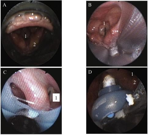 This set of four fiberscopic images (A-D) illustrates the anatomical positioning of various supraglottic airway (SGA) devices relative to the larynx. Panel A shows the i-gel™ device with the glottic inlet (1) and arytenoids (2) clearly visible; the epiglottis is notably resting inside the mask bowl. Panel B displays the LMA-Supreme™, showing similar anatomical landmarks but with visible narrowing of the vocal cords and slightly hyperemic tissue. Panels C and D demonstrate laryngeal views with the Laryngeal Tube Suction-D (LTS-D) in situ. These views illustrate suboptimal or 'awkward' positioning where the device partially obscures the glottic structures, although ventilation remains possible. Across all images, the laryngeal mucosa appears pink and moist, indicating healthy tissue perfusion. This comparative series serves as an educational tool for anesthesiology and emergency medicine to understand how different SGA designs impact glottic visualization and airway alignment during clinical practice.