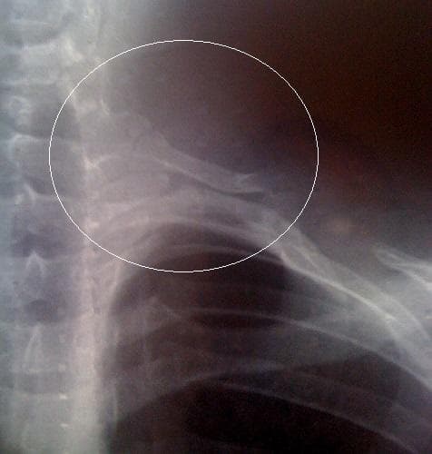 This diagnostic image is an anteroposterior (AP) chest X-ray radiography focusing on the superior thoracic aperture and cervical-thoracic junction. The radiograph reveals the presence of a cervical rib (supernumerary rib), highlighted within a white circular annotation. The cervical rib originates from the seventh cervical vertebra (C7) and appears as a curved, radiopaque bony structure extending laterally and inferiorly toward the first rib. The surrounding anatomy includes the cervical and upper thoracic spine, multiple standard ribs, and the clavicle. The visual evidence illustrates a congenital anatomical variation that is clinically significant as a potential cause of thoracic outlet syndrome (TOS) due to compression of neurovascular structures. The image is intended for educational use in radiology and musculoskeletal anatomy to help learners identify skeletal anomalies and understand their relationship to adjacent neurovascular pathways.