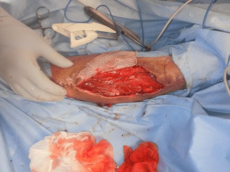 This clinical photograph captures an intraoperative view of a skin grafting procedure on the right upper extremity following the removal of a subcutaneous hematoma. The surgical site consists of a large, longitudinal open wound revealing deep red, viable-appearing underlying tissue and muscle fascia. A white, meshed skin graft is being applied to the wound bed, partially covering the proximal portion of the defect. Surgical staples and interrupted sutures are visible along the wound margins, securing the edges. Visible in the sterile field are essential surgical tools, including a white plastic skin stapler, metal forceps, and blood-soaked gauze sponges, indicating active hemostasis and wound closure. The image demonstrates the management of skin necrosis and large soft-tissue defects using split-thickness skin grafting techniques in a clinical setting related to compartment syndrome or deep dissecting hematoma (DDH).