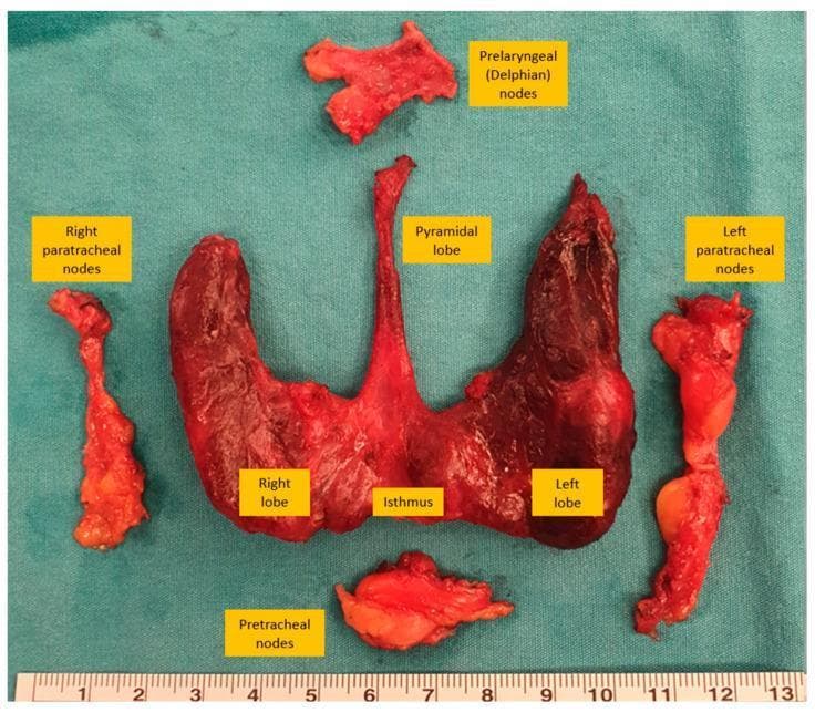 This clinical photograph shows a gross surgical specimen from a bilateral total thyroidectomy and central compartment (Level VI) neck dissection, arranged anatomically on a green sterile field with a centimeter scale. The main thyroid specimen consists of the right and left lobes connected by a central isthmus, with a distinct, elongated pyramidal lobe extending superiorly from the isthmus. Surrounding the gland are four excised lymph node groups: the prelaryngeal (Delphian) nodes located superiorly, the pretracheal nodes positioned inferiorly, and the right and left paratracheal nodes arranged laterally to their respective thyroid lobes. The thyroid tissue appears fleshy and deep red, while the associated lymph node packets appear as lighter, yellowish-pink fibrofatty tissue masses. This image serves as an educational reference for surgical anatomy and the extent of central neck dissection in the management of thyroid malignancies.