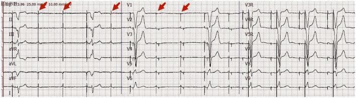 An eighteen-channel surface electrocardiogram (ECG) tracing, including standard limb leads (I, II, III, aVR, aVL, aVF), precordial leads (V1-V6), and additional right-sided/posterior leads (V3R, V4R, V5R, V8, V9). The tracing demonstrates a transient failure of ventricular pacing capture in a patient with a dual-chamber pacemaker. Red arrows specifically indicate ventricular pacing spikes that are not followed by a QRS complex, indicating 'failure to capture.' In segments where capture is successful, a wide QRS complex follows the pacing spike, consistent with ventricular pacing. The underlying atrial rhythm shows P waves, suggesting atrial sensing or pacing (DDD mode). Leads V1 through V3 show predominantly negative QRS complexes with T-wave inversions, while the lateral leads show increasing R-wave amplitude. This diagnostic image illustrates a critical pacemaker malfunction, clinically relevant for identifying causes of syncope in paced patients, such as lead displacement, electrolyte imbalances, or increased myocardial thresholds due to underlying pathology like pulmonary embolism.