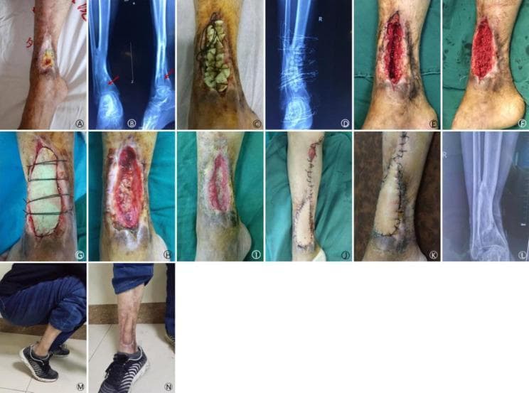 A multi-panel clinical photograph and radiographic sequence documenting the 15-month treatment progression of a 52-year-old male with a chronic open fracture and sinus tract of the right distal tibia. The series begins with (A-B) initial presentation showing a distal tibial wound and X-ray evidence of a metaphyseal bone defect. Subsequent panels (C-G) illustrate Masquelet-like technique stages, including the implantation of antibiotic-impregnated cement beads, followed by autologous bone grafting (iliac bone) and application of a bone cement sheet (BCS). Intermediate stages (H-I) demonstrate the debridement of necrotic graft particles and the formation of granulation tissue. Reconstructive surgery is shown in (J-K) via a medial leg flap for soft tissue coverage. The final panels (L-N) provide a 15-month follow-up, showing radiographic bone union, successful wound closure, and restored functional mobility (ankle dorsiflexion). This educational sequence highlights orthopedic management of complex bone defects, staged reconstruction using spacers/grafts, and soft tissue flap coverage.