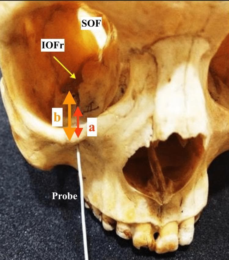 Anatomical anatomical illustration and clinical photograph of a human dry skull focusing on the right infraorbital and orbital regions for morphometric study. A metallic linear probe is inserted into the right infraorbital foramen, demonstrating the trajectory of the infraorbital canal. Key landmarks are labeled: the Superior Orbital Fissure (SOF) and the Inferior Orbital Fissure (IOFr). Two vertical measurement indicators are shown relative to the inferior orbital rim: arrow 'a' represents the distance from the rim to the anterior part of the infraorbital groove, and arrow 'b' represents the distance to the anterior-most extent of the inferior orbital fissure. These measurements help define the clinical anatomy of the infraorbital canal, which is vital for safe anesthetic nerve blocks and maxillofacial surgical procedures. Visible adjacent structures include the nasal cavity, the maxillary sinus region, and the superior alveolar process with maxillary teeth.