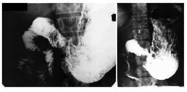 Two side-by-side abdominal fluoroscopic images from a barium swallow or upper gastrointestinal series demonstrating gastric emptying in a postoperative patient. The left image shows the stomach and proximal small intestine filled with radiopaque barium contrast. The stomach is distended with a high-density contrast column, showing clear visualization of the gastric anatomy and initial transit into the duodenum. The right image, taken at a subsequent time interval, displays physiological gastric emptying. The gastric volume is visibly reduced, and the contrast material has transitioned into the distal duodenum and jejunal loops. The vertebral column serves as a midline anatomical landmark. These images are used to assess gastrointestinal motility, transit time, and the patency of surgical anastomoses (such as gastrojejunalduodenostomy) following procedures for peptic ulcer disease, ensuring the absence of dumping syndrome or mechanical obstruction.