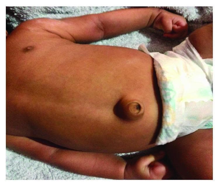 This clinical photograph displays the torso of an infant in a supine position, highlighting a classic infantile umbilical hernia. The primary finding is a prominent, rounded protrusion localized at the umbilical region. The hernia is covered by intact, smooth skin that is continuous with the abdominal wall, showing normal coloration without signs of inflammation, erythema, or strangulation. The umbilicus is visible at the apex of the swelling. The abdomen appears slightly distended, and the surrounding skin texture demonstrates healthy turgor. This image serves as a pedagogical example of a common pediatric congenital condition, illustrating the characteristic 'outie' appearance caused by a defect in the abdominal wall fascia through which intra-abdominal contents, such as small bowel loops or omentum, can bulge. It is used in medical education to teach visual diagnosis of reducible umbilical hernias and to distinguish them from other abdominal wall defects like omphalocele or gastroschisis.