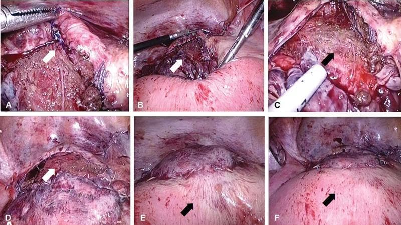 This series of six laparoscopic clinical photographs (a-f) documents the surgical removal of uterine compression sutures in a postpartum patient. Image (a) depicts the initial stage of the procedure, with laparoscopic forceps grasping a violet-colored suture thread. Panels (b) and (c) show the lower uterine segment before suture removal, characterized by visible violet compression sutures and tissue that appears dark and congested, suggesting focal ischemia. Panel (d) illustrates the same lower uterine segment immediately following suture removal, showing a reduction in dark discoloration. Panels (e) and (f) provide a comparative visual inspection of the anterior uterine wall. In (e), the wall exhibits a darker, congested hue prior to suture release. In (f), the anterior uterine wall shows a distinct transition to a pinkish-white and pinkish-red color, indicating improved tissue perfusion and the resolution of venous congestion. This educational material demonstrates the laparoscopic management of suspected uterine ischemia following B-Lynch or similar compression suturing techniques used for postpartum hemorrhage.