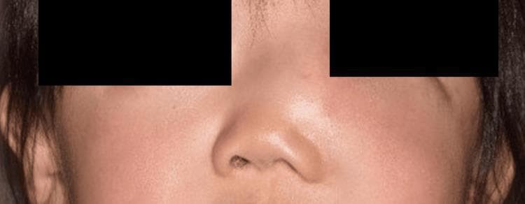 This clinical photograph shows a close-up frontal view of a patient's face, specifically focusing on the nasal and midface region. A prominent, localized swelling is visible on the left side of the nasal dorsum, extending toward the medial infraorbital area. The mass causes a significant loss of facial symmetry, with a visible bulge that displaces the normal contours of the nose and the lower medial eyelid. The overlying skin appears slightly erythematous with subtle fullness, though it remains intact without ulceration. This presentation is characteristic of a soft tissue tumor or cystic lesion of the sinonasal region, such as a solitary myofibroma (SNM), as suggested by the clinical history of recurrence and rapid growth. The image effectively demonstrates the clinical manifestation of a midfacial mass and its impact on regional anatomical landmarks, including the nasal bone and lacrimal drainage pathway.