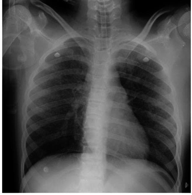Anterior-Posterior (AP) chest X-ray of a pediatric patient demonstrating a classic 'millet seed' pattern. The image shows widespread, diffuse, and symmetric tiny nodular opacities distributed throughout both the right and left lung fields, from the apices to the bases. These micronodular densities are discrete and uniform in size, characteristic of miliary tuberculosis. The cardiac silhouette, mediastinum, and trachea appear within normal limits for the patient's age. Osseous structures, including the clavicles, ribs, and shoulders, are clearly visible. The presentation illustrates the typical radiological findings associated with hematogenous dissemination of Mycobacterium tuberculosis. This diagnostic image serves as an educational example of miliary lung disease and its manifestation in clinical radiography within a Pediatric Intensive Care Unit (PICU) context.