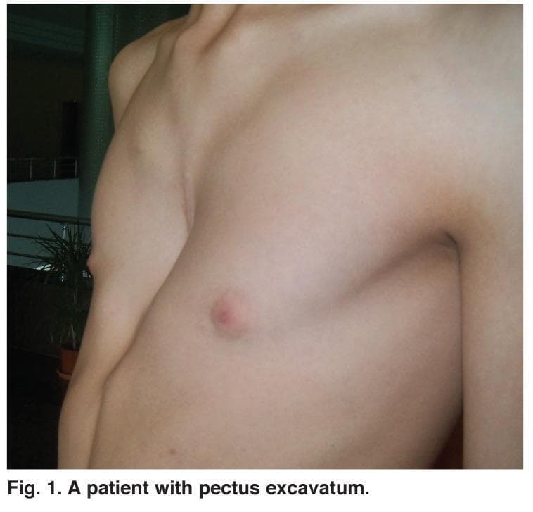 This clinical photograph shows a three-quarter view of a patient's torso, illustrating a classic presentation of pectus excavatum (funnel chest). The primary feature is a significant posterior depression of the sternum and adjacent costal cartilages, resulting in a concave anterior chest wall. The deformity is centered on the lower half of the sternum, with a slight lateral asymmetry where the left hemi-thorax appears more deeply recessed than the right. The skin overlying the deformity is intact, smooth, and free of surgical scars, lesions, or vascular abnormalities. The bony landmarks of the shoulder girdle and clavicles appear normal, while the subcutaneous fat is minimal, highlighting the skeletal indentation. This image serves as an educational example of a congenital chest wall deformity, relevant for thoracic surgery and pediatric orthopedics, specifically for evaluating morphological severity prior to surgical interventions such as the Nuss or Ravitch procedures.