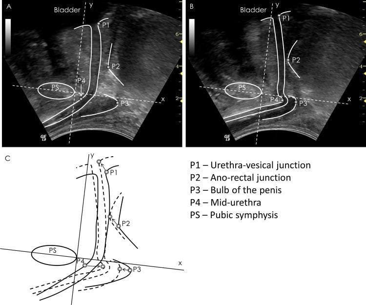 This composite educational graphic features diagnostic transperineal ultrasound images and a schematic diagram illustrating male pelvic floor dynamics. Panels A and B present sagittal ultrasound views in relaxed and contracted states, respectively, with superimposed anatomical markers. Key landmarks identified include the bladder, pubic symphysis (PS), urethra-vesical junction (P1), ano-rectal junction (P2), bulb of the penis (P3), and mid-urethra (P4). Panel C is a comparative line diagram that overlays the relaxed (dashed lines) and contracted (solid lines) positions of these structures relative to the pubic symphysis. Displacement vectors (arrows) demonstrate the cranial and ventral movement of the pelvic floor landmarks during voluntary contraction. The content is designed to teach pelvic floor functional anatomy and the calculation of landmark displacement, which is clinically relevant for assessing pelvic floor muscle function and treating conditions like urinary incontinence or pelvic floor dysfunction in males.