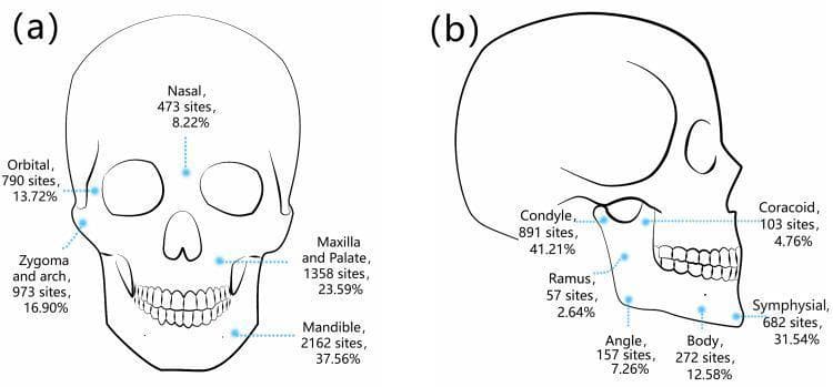 This medical illustration consists of two labeled diagrams (a and b) detailing the anatomical distribution and frequency of maxillofacial fractures. Diagram (a) presents an anterior view of a human skull, categorizing general fracture sites: Mandible (37.56%), Maxilla and Palate (23.59%), Zygoma and arch (16.90%), Orbital (13.72%), and Nasal (8.22%). Diagram (b) provides a lateral view specifically focusing on mandibular fracture sub-sites. It identifies the Condyle as the most frequent site (41.21%), followed by the Symphysial region (31.54%), Mandibular Body (12.58%), Mandibular Angle (7.26%), Coracoid (4.76%), and Ramus (2.64%). Each label includes the total number of sites and the corresponding percentage based on a clinical study of 1,828 patients. This comparison chart serves as an educational tool for oral and maxillofacial surgery, illustrating common patterns of facial trauma and identifying the mandible, particularly the condyle, as a high-risk area for fractures.