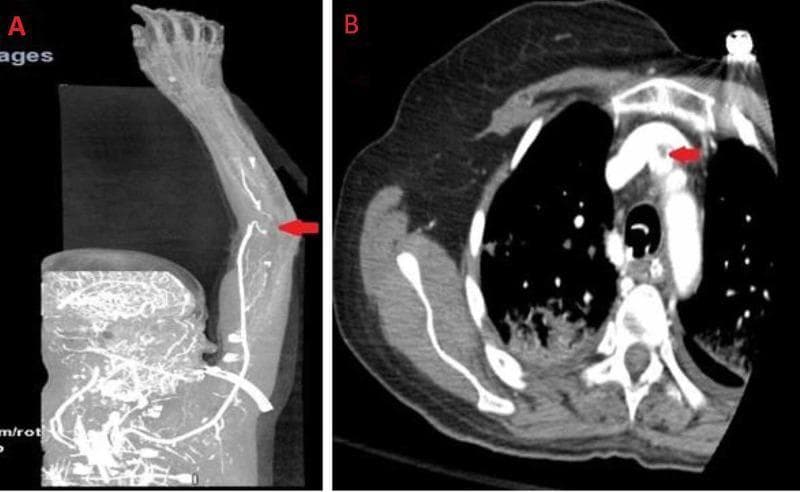 This figure consists of two computed tomography (CT) angiogram images highlighting vascular pathology in the right upper extremity and mediastinum. Image A is a maximum intensity projection (MIP) reconstruction showing the right upper limb arterial supply. A red arrow points to an occlusion at the distal bifurcation of the brachial artery. There is a conspicuous absence of contrast enhancement in the radial and ulnar arteries, indicating distal ischemia and lack of flow. Image B is an axial CT scan of the chest at the level of the aortic arch. A red arrow identifies a localized filling defect within the origin of the right innominate (brachiocephalic) artery, consistent with a small mural thrombus. The surrounding vessel walls and mediastinal structures appear otherwise unremarkable. These images serve as educational examples of arterial embolism or thrombosis leading to acute limb ischemia, emphasizing the importance of recognizing filling defects and abrupt vascular cut-offs in cross-sectional imaging.
