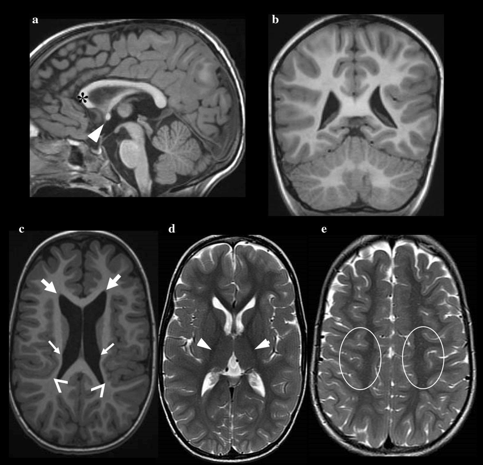This composite of brain MRI scans demonstrates several diagnostic features associated with a pediatric neurodevelopmental condition. The sagittal T1-weighted image (a) reveals a thinning of the genu of the corpus callosum (asterisk) and relative hypertrophy of the anterior commissure (white arrowhead). A scaphocephalic skull morphology is also visible. Sagittal and coronal T1-weighted views (a, b) show a normal cerebellum. The axial T1-weighted image (c) highlights dysmorphic lateral ventricles, specifically showing dilatation of the frontal horns (thick arrows) and irregular, scalloped ventricular walls (thin arrows). A reduction in insulo-temporal white matter volume is also marked (chevron). In contrast, axial T2-weighted images (d, e) demonstrate preserved signal intensity within the white matter of the posterior limb of the internal capsule (white arrowheads) and the paracentral region (ovals). These findings are characteristic of neuroradiological manifestations in specific types of Congenital Disorders of Glycosylation (CDG), illustrating structural brain anomalies despite relatively preserved white matter signal.