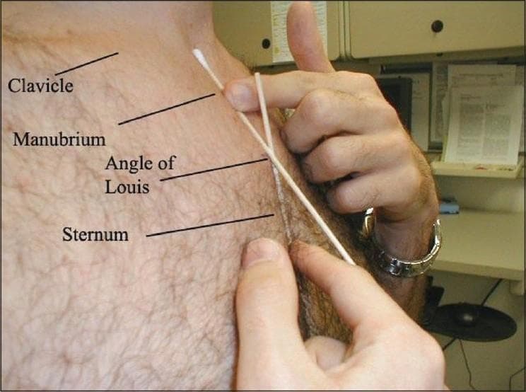 A clinical photograph and procedural image illustrating the surface anatomy and landmarks of the upper thoracic region. The image depicts a clinician's hands identifying and palpating key anatomical structures on a patient's chest for the purpose of placing a radiopaque marker. Labeled anatomical landmarks from superior to inferior include the clavicle, manubrium, angle of Louis (sternal angle), and the body of the sternum. The clinician is using a cotton swab and a thin rod as temporary external markers to localize the angle of Louis, which serves as a critical clinical reference point for assessing central venous catheter tip positioning. The photograph demonstrates the anatomical relationship between the manubriosternal junction and surrounding thoracic structures, highlighting its relevance in critical care and radiology for ensuring optimal procedural placement within a specified range above or below the sternal angle.