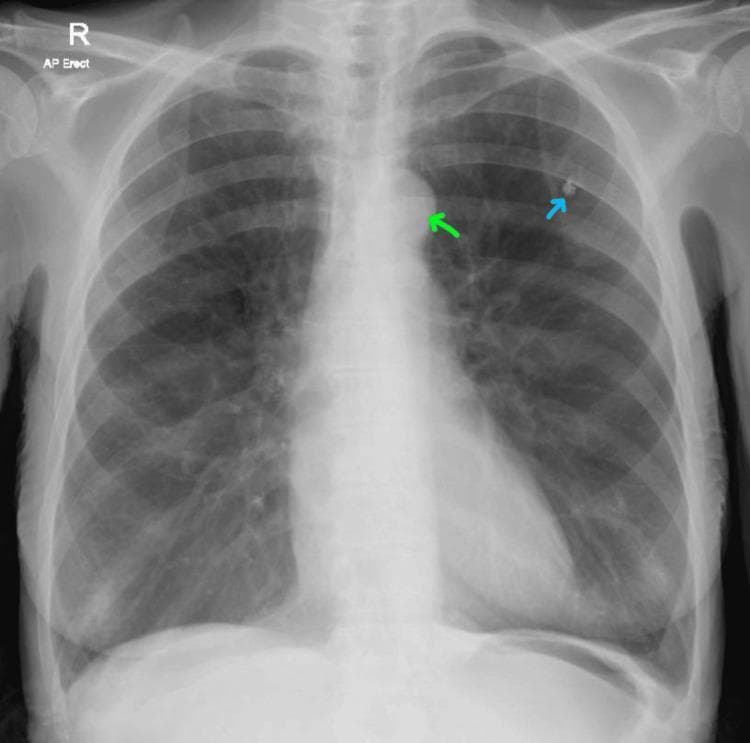 This diagnostic image is an anteroposterior (AP) erect chest X-ray demonstrating several key clinical findings. The lungs show signs of hyperinflation, characterized by increased radiolucency and a flattened appearance of the bilateral diaphragmatic domes, consistent with chronic obstructive pulmonary disease (COPD). Two specific findings are highlighted with color-coded arrows: a blue arrow points to a small, well-defined calcified granuloma located in the left upper lung zone, and a green arrow indicates an enlarged aortic knob, often associated with chronic hypertension. The cardiac silhouette appears within normal size limits, though the overall lung volume is increased. This image serves as an educational example for identifying radiographic signs of obstructive lung disease alongside common incidental thoracic findings like granulomas and vascular changes.