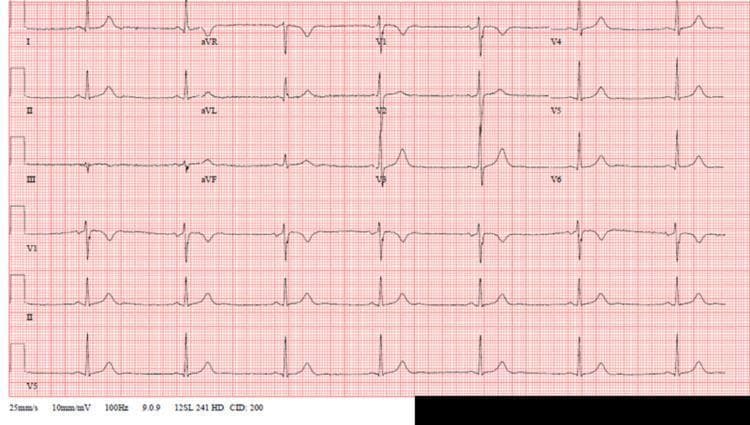 A standard 12-lead electrocardiogram (ECG) displayed on a red grid background with calibration set at 25 mm/s and 10 mm/mV. The tracing demonstrates a regular rhythm characterized by a slow heart rate (approximately 40-45 beats per minute), consistent with sinus bradycardia. Each QRS complex is preceded by a normal P wave with a constant PR interval (approximately 160-200 ms), indicating 1:1 atrioventricular conduction without evidence of AV blocks. The QRS complexes are narrow (under 120 ms) with normal morphology and a normal axis. ST segments are isoelectric throughout all leads (I, II, III, aVR, aVL, aVF, and V1-V6), and T waves appear normal in amplitude and direction without evidence of acute ischemia or electrolyte imbalances. This diagnostic image is used in cardiology and internal medicine to illustrate sinus bradycardia in a clinical setting.