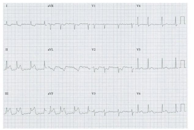 A standard 12-lead diagnostic electrocardiogram (ECG) demonstrating a transient ST-segment elevation in the inferior leads (II, III, and aVF). The morphology in these leads shows marked ST elevation with an upright T wave, consistent with an acute inferior wall injury pattern. The QRS complexes are narrow and preceded by visible P waves, indicating a sinus rhythm. Reciprocal ST-segment depression is visible in leads I and aVL. This specific tracing illustrates a Bezold-Jarisch-like reflex, a physiological phenomenon that can occur due to mechanical irritation of the interatrial vagal network during transseptal puncture, leading to coronary artery spasm. The image serves as a clinical example for recognizing procedure-related cardiac changes and differentiating them from primary atherosclerotic myocardial infarction in the context of electrophysiology interventions.