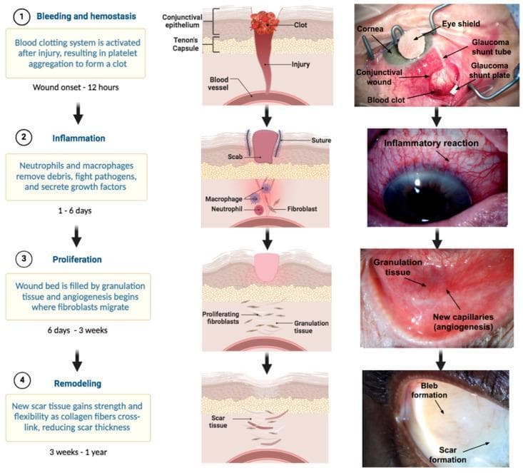This infographic and clinical photograph series illustrates the four stages of ocular wound healing following glaucoma filtration surgery (e.g., shunt implantation). The diagram is organized into four horizontal rows representing the chronological phases: (1) Bleeding and Hemostasis (0–12 hours), showing platelet aggregation and a visible blood clot at the conjunctival wound site alongside surgical elements like the glaucoma shunt tube and plate. (2) Inflammation (1–6 days), characterized by neutrophil and macrophage recruitment and a clinical appearance of diffuse episcleral/conjunctival injection (redness). (3) Proliferation (6 days–3 weeks), showing fibroblast migration, collagen deposition, and angiogenesis (new capillary formation) clinical visible as fleshy granulation tissue. (4) Remodeling (3 weeks–1 year), depicting scar tissue maturation and the formation of a functional surgical bleb. The figure combines anatomical cross-sections of the conjunctiva and Tenon's capsule with real-world clinical images to demonstrate the physiological transition from acute injury to long-term surgical outcome in ophthalmology.