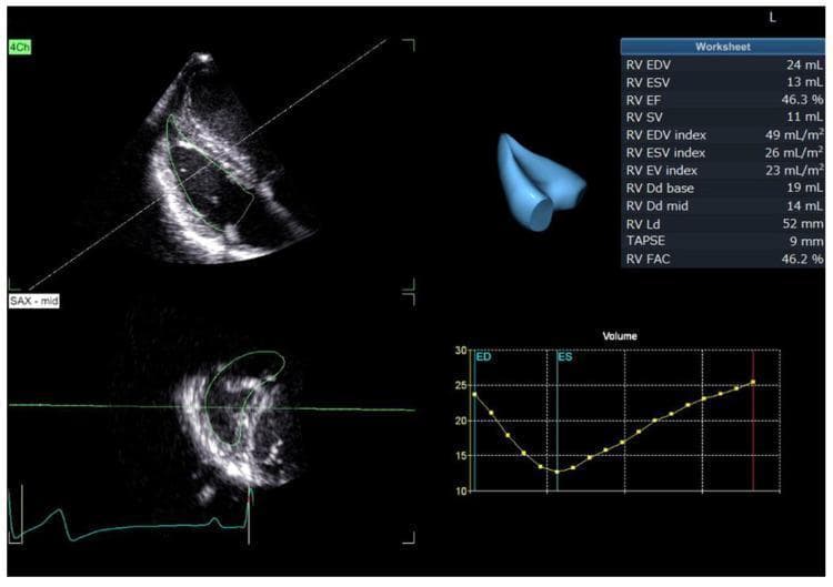 This diagnostic image displays a quad-pane interface from a real-time three-dimensional echocardiography (RT3DE) system used for automated right ventricular (RV) quantification. The top-left panel shows an apical four-chamber (4Ch) view optimized for the right heart, featuring a green contour of the automatically traced endocardial border. The bottom-left panel provides a short-axis view (SAX-mid) of the ventricle, also with a green endocardial trace and an electrocardiogram (ECG) lead at the bottom. The top-right quadrant includes a 3D surface rendering of the RV volume alongside a 'Worksheet' detailing clinical measurements: RV End-Diastolic Volume (EDV, 24 mL), RV End-Systolic Volume (ESV, 13 mL), RV Ejection Fraction (EF, 46.3%), and Stroke Volume (SV, 11 mL), plus indexed values and linear dimensions (TAPSE, FAC). The bottom-right panel displays a volume-time graph showing the dynamic changes in RV volume over one cardiac cycle, with markers for end-diastole (ED) and end-systole (ES). This tool facilitates comprehensive hemodynamic assessment and structural evaluation of the right heart in cardiology.