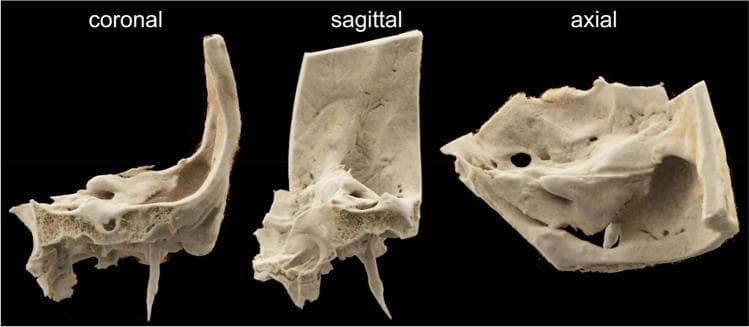 This diagnostic image displays a high-resolution Volume Rendering Technique (VRT) reconstruction of a human temporal bone specimen, presented in three standard anatomical planes: coronal, sagittal, and axial. The reconstruction highlights the complex morphology of the petrous and squamous portions of the temporal bone. The coronal view reveals the vertical orientation of the squamous part and the styloid process extending inferiorly, while showing the porous trabecular nature of the mastoid region. The sagittal view illustrates the anteroposterior depth and the density variations between the cortical surface and the internal cancellous bone. The axial view provides a superior perspective, showcasing the internal acoustic canal, various foramina, and the irregular contours of the petrous ridge. This visual is intended for educational purposes in radiology and otolaryngology, demonstrating the capabilities of advanced CT scanning protocols (such as MS-CT and FD-CT) in visualizing minute anatomical structures, bony landmarks, and surface textures of the ear's structural foundation.