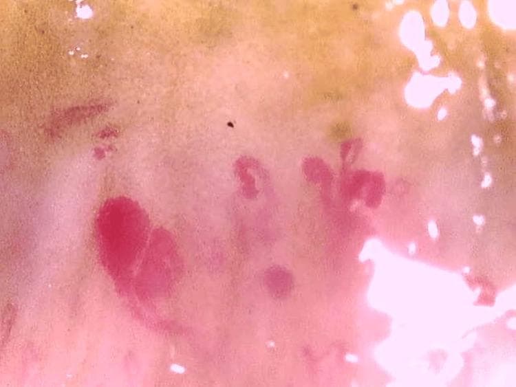 This clinical diagnostic image shows a nailfold capillaroscopy procedure, a key diagnostic tool in rheumatology for evaluating microvascular changes. The image displays classic findings associated with an 'active' scleroderma pattern, frequently seen in systemic sclerosis (SSc). Visible features include prominent giant capillaries (megacapillaries) characterized by significant, bulbous dilation and irregular vessel morphology. Several dark red focal lesions represent microhemorrhages, resulting from the rupture of these fragile, ectatic capillaries. Furthermore, the image shows a non-uniform distribution of vessels with apparent gaps, indicating capillary dropout or loss of the normal hairpin loop architecture. These microvascular abnormalities are clinically significant for the assessment of Raynaud phenomenon and the diagnosis of connective tissue diseases, reflecting the underlying vasculopathy of scleroderma-spectrum disorders.