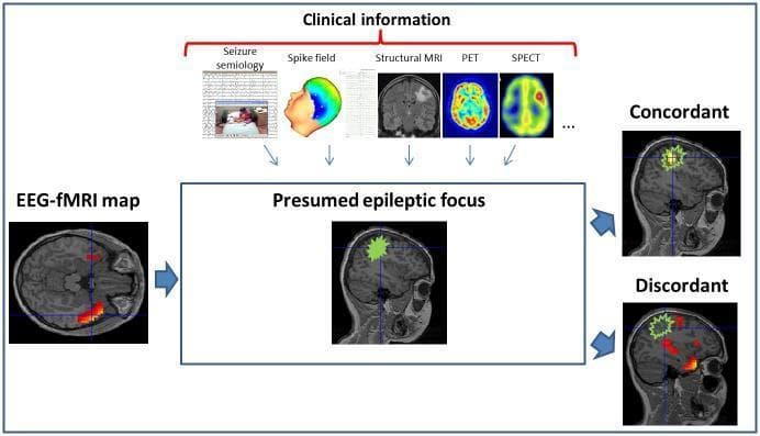 A multimodal diagnostic infographic illustrating the clinical assessment and validation of EEG-fMRI maps in epilepsy. The diagram organizes diverse clinical information used to define a 'Presumed epileptic focus,' including seizure semiology (EEG trace and video), spike field topography, structural MRI (T1-weighted), PET, and SPECT imaging. The central 'Presumed epileptic focus' is represented on a sagittal T1 MRI slice by a green-highlighted region. The infographic demonstrates the methodology for classifying an EEG-fMRI map as 'Concordant' or 'Discordant' based on the spatial overlap between significant BOLD signal changes (indicated by red-to-yellow heat maps) and the clinically defined focus. A concordant map shows BOLD activation within the green-contoured zone, whereas a discordant map displays activation clusters outside this region. This visual highlights the integration of electrophysiological and hemodynamic data for precise neuroanatomical localization of interictal epileptiform discharges (IEDs) in pediatric and adult epilepsy research.