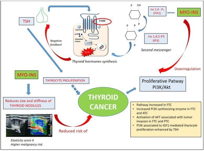 This pathophysiology diagram illustrates the regulatory role of Myo-inositol (MYO-INS) in thyroid function and its protective mechanisms against thyroid cancer. The diagram maps two primary pathways: first, MYO-INS serves as a precursor to phosphoinositide second messengers (PIP2 and IP3), which facilitate thyroid hormone synthesis. Increased T3 and T4 levels then exert negative feedback on TSH secretion, thereby inhibiting TSH-driven thyrocyte proliferation. Second, MYO-INS is shown to downregulate the PI3K/Akt proliferative pathway, which is typically overactive in follicular (FTC), anaplastic (ATC), and papillary thyroid cancer (PTC). A clinical component includes ultrasound elastography images showing a thyroid nodule with high stiffness (Elasticity score 4); the diagram indicates that MYO-INS reduces the size and stiffness of such nodules, ultimately leading to a reduced risk of thyroid cancer. Key molecular elements include TSHR signaling, cAMP, and IGF1-mediated proliferation, highlighting the transition from benign nodules to malignancy.