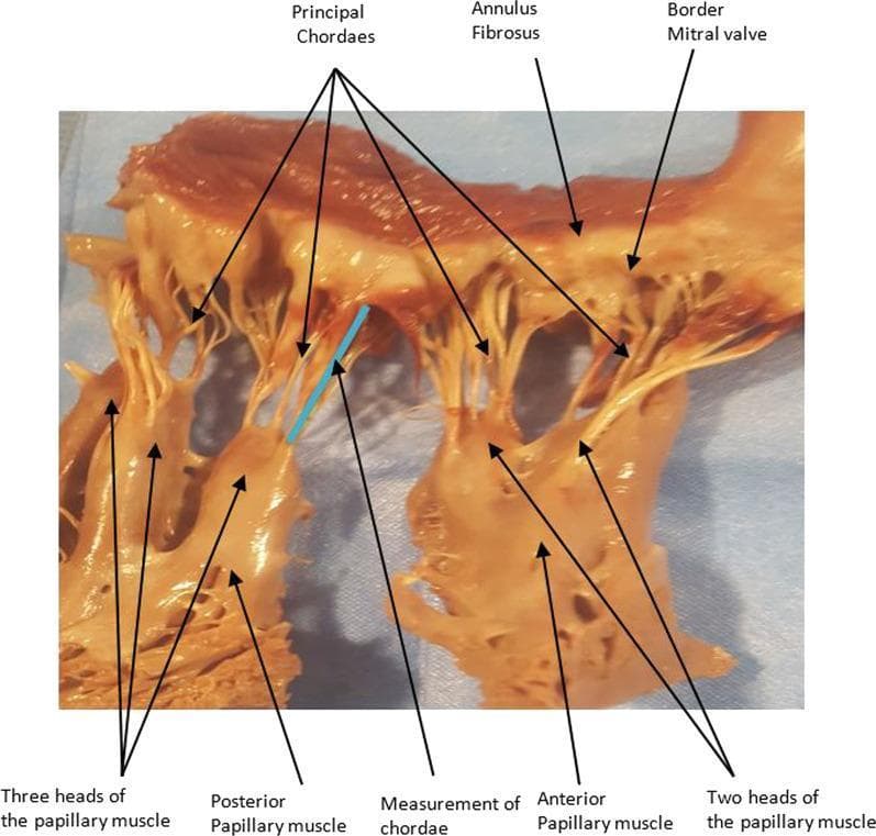 Anatomical photograph of a dissected human mitral valve apparatus, illustrating the subvalvular structures. The image features a detailed view of the anterior and posterior papillary muscles and their respective heads; specifically, the anterior papillary muscle is shown with two heads, while the posterior papillary muscle exhibits three heads. Multiple 'principal chordae' tendineae are clearly visible as fibrous cords connecting the papillary muscle heads to the mitral valve leaflets. The 'annulus fibrosus' (the fibrous ring of the valve) and the 'border of the mitral valve' are labeled at the superior portion of the specimen. A blue line indicates the 'measurement of chordae,' demonstrating the methodology for quantifying subvalvular dimensions. This clinical image is primarily used for anatomical study, surgical planning for mitral valve repair, and understanding the complex morphology of the left ventricular outflow tract and valvular support system.