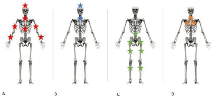 This Comparison Chart consists of four anatomical skeletal diagrams (A, B, C, and D) illustrating the distribution of skeletal lesions based on different mechanisms of trauma, commonly used in forensic medicine and traumatology. Diagram A shows a fall onto the head with defense attempt, indicated by star markers on the skull, cervical spine, shoulders, upper arms, and distal forearms (wrists). Diagram B represents a fall onto the head without defense attempt, showing localized markers on the skull and cervical spine only. Diagram C depicts a fall onto the feet (axial loading), with markers concentrated on the pelvic girdle, proximal femurs, and distal femurs/knees. Diagram D illustrates a specific clinical case where lesions are isolated to the cervical spine, sternum, and bilateral rib cage, which clinically excludes a standard fall mechanism. These illustrations serve to educate on the correlation between injury patterns and primary impact zones in blunt force trauma and fall scenarios.