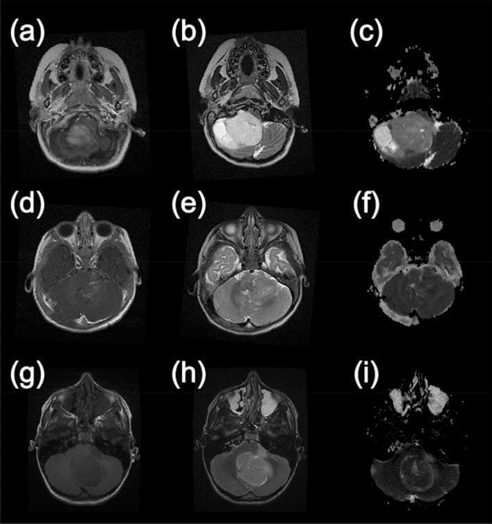 A comparison grid of axial magnetic resonance imaging (MRI) scans demonstrating common pediatric posterior fossa tumors across three imaging modalities: T1-weighted post-gadolinium contrast (left column), T2-weighted (middle column), and Apparent Diffusion Coefficient (ADC) maps (right column). Row 1 (a-c) illustrates a Pilocytic Astrocytoma, characterized by a large, heterogeneous, T2-hyperintense mass with high ADC values (bright signal), reflecting its cystic/microcystic nature. Row 2 (d-f) displays an Ependymoma, showing intermediate T2 signal and intermediate ADC values with less defined borders. Row 3 (g-i) shows a Medulloblastoma, appearing as a midline mass with moderate contrast enhancement and restricted diffusion, evidenced by low ADC values (dark signal) indicating high cellularity. This comparison highlights the diagnostic utility of diffusion-weighted imaging (DWI) and ADC mapping in differentiating pediatric brain tumors by evaluating tissue microstructure and cellular density alongside conventional anatomical sequences.