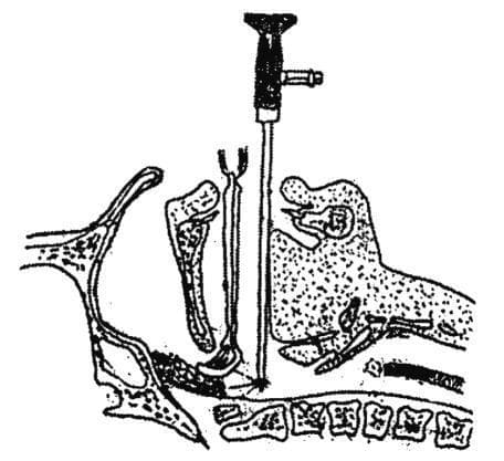 A sagittal cross-sectional anatomical diagram illustrating the technique for endoscopically assisted adenoidectomy. The diagram depicts the head and neck anatomy, including the nasal cavity, hard palate, soft palate, tongue, and cervical vertebrae. Two surgical instruments are shown inserted transorally into the nasopharynx: an adenoid curette and a 70-degree nasal endoscope. The curette, identifiable by its loop-shaped distal tip, is positioned superiorly to engage the adenoid tissue mass on the posterior nasopharyngeal wall. Simultaneously, a rigid endoscope is introduced posterior to the curette, providing direct visualization of the surgical field to ensure complete resection and avoid injury to adjacent structures like the Eustachian tube orifices. The clinical significance of this illustration is to demonstrate the spatial relationship between the instruments during a combined endoscopic-curettage procedure for treating adenoid hypertrophy. This material is relevant for otolaryngology training, specifically for surgical planning and understanding the anatomical approach to the nasopharynx.
