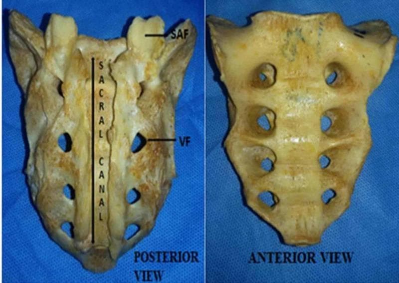 Clinical photograph of a dry human sacrum bone specimen, displaying both the posterior (dorsal) and anterior (ventral/pelvic) views side-by-side. The image highlights a significant anatomical variation: complete agenesis of the dorsal wall of the sacral canal, also known as spina bifida occulta or a total sacral hiatus. In the posterior view, the sacral canal is entirely exposed along its length due to the failure of the laminae to fuse in the midline. Key labeled structures include the Superior Articular Facets (SAF) at the cranial end and the Vertebral Foramina (VF) positioned laterally to the midline canal. The anterior view demonstrates normal anatomy with a smooth, concave pelvic surface and four pairs of symmetric anterior sacral foramina. This specimen serves as an educational example of developmental vertebral anomalies and anatomical variation in the axial skeleton, relevant to anatomy, radiology, and neurosurgery.