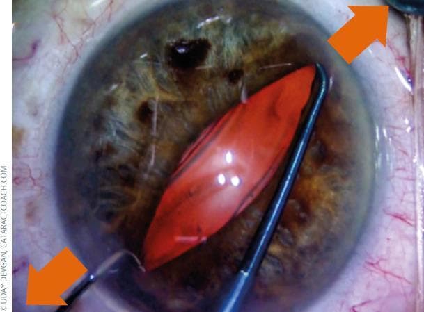This clinical photograph captures an intraoperative ophthalmologic procedure, specifically a mechanical pupil stretching technique used during cataract surgery or in cases of small pupil management (miosis). The image shows the anterior segment of a human eye with two surgical hooks positioned approximately 180 degrees apart. These instruments are engaged at the pupillary margin, applying outward radial tension toward the limbus to expand the pupil, which appears elongated and oval-shaped. The iris exhibits a mixed brownish-green pigmentation. Within the center of the dilated pupil, an orange-red reflex or structure is visible, likely representing the lens nucleus or a red reflex from the fundus. The surrounding sclera and bulbar conjunctiva show mild hyperemia with visible fine vasculature. Orange arrows are superimposed on the image to indicate the directional force of the mechanical dilation. This visual demonstrates a critical surgical step in facilitating access to the lens when pharmacological dilation is insufficient.