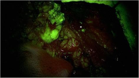 This clinical photograph displays an intraoperative surgical field of the parotid gland region during a tumor resection, captured using fluorescence-guided surgery with a 560 nm yellow filter. The image demonstrates high-contrast visualization of neoplastic tissue against dark background anatomical structures. A large, lobulated mass in the upper left quadrant exhibits intense green fluorescence, indicating active accumulation of a fluorescent tracer within the tumor. In the center-right of the surgical bed, a small, discrete punctate area of fluorescence is marked with an asterisk (*), identifying a small nest of residual tumor or a satellite nodule that may not be easily visible under standard white light. The surrounding healthy tissues, including the facial nerve branches and background stroma, appear in dark reddish-brown tones with minimal to no fluorescence. This imaging technique is utilized in otorhinolaryngology to improve oncological margins and facilitate the identification of microscopic residual disease in complex anatomical regions like the parotid gland.