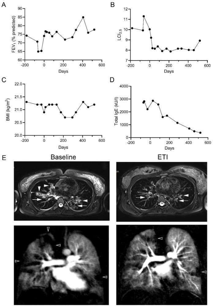 This composite educational graphic illustrates clinical and radiological changes in a Cystic Fibrosis (CF) patient carrying the G85E mutation following elexacaftor/tezacaftor/ivacaftor (ETI) therapy. Panels A-D present longitudinal line graphs showing clinical metrics from 200 days pre-initiation to 600 days post-initiation: (A) FEV1 % predicted increases, (B) Lung Clearance Index (LCI2.5) decreases, (C) Body Mass Index (BMI) remains stable, and (D) Total Serum IgE (kU/l) shows a marked decline. Panel E displays representative axial T2-weighted and perfusion MRI scans comparing 'Baseline' and 'ETI' treatment states. At baseline, white arrows indicate significant bronchial wall thickening and bronchiectasis, while white arrowheads highlight mucus plugging. Black arrowheads in the perfusion MRI denote regions of impaired lung perfusion. Post-ETI MRI images demonstrate notable resolution of mucus plugging and a decrease in perfusion abnormalities, signifying improved airway clearance and pulmonary vascular distribution. This material is designed for medical professionals studying CFTR modulator efficacy and pulmonary imaging manifestations in cystic fibrosis.