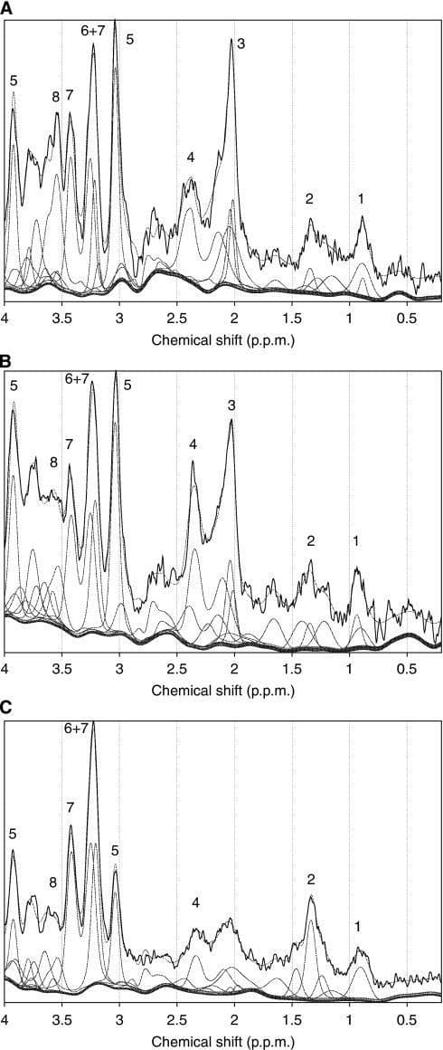 This diagnostic image displays three 1H MR spectra (A, B, and C) comparing metabolic profiles in mouse cerebella across wild-type (WT) and Smoothened (SMO) medulloblastoma models. The x-axis represents the chemical shift in parts per million (p.p.m.), and the y-axis shows signal intensity. Spectrum A (WT) serves as the control, showing prominent peaks for N-acetyl aspartate (NAA at 2.0 p.p.m., label 3), creatine (3.0 p.p.m., label 5), and choline-containing metabolites (3.2 p.p.m., label 6). Spectrum B shows a pre-symptomatic SMO cerebellum with a profile largely similar to the control. Spectrum C illustrates the metabolic hallmark of a T2-hyperintense tumor, characterized by a severe reduction in the NAA peak (marker of neuronal integrity) and a significant elevation in choline (label 6+7) and taurine (label 7) peaks, indicating high cell turnover and tumor progression. Other assigned peaks include lipids/macromolecules (0.9–1.3 p.p.m.), glutamate/glutamine (2.1–2.4 p.p.m.), and glycine/myo-inositol (3.5–3.6 p.p.m.). The visualization demonstrates the utility of magnetic resonance spectroscopy in identifying biochemical biomarkers for pediatric-type brain tumors.