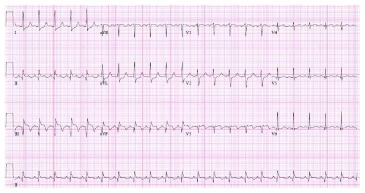 A 12-lead electrocardiogram (ECG) demonstrating signs of an acute inferior wall ST-elevation myocardial infarction (STEMI). The visual shows prominent, convex ST-segment elevation in the inferior leads: II, III, and aVF. Concurrent reciprocal ST-segment depression is visible in the lateral leads, specifically I and aVL, a hallmark finding that supports the diagnosis of acute inferior injury. The precordial leads (V1-V6) show a standard R-wave progression. The QRS complexes appear narrow, and the rhythm is regular. This diagnostic tracing is a critical educational example used to identify coronary artery occlusion, typically involving the right coronary artery (RCA). It is suitable for medical students and clinicians learning to distinguish between different territorial patterns of myocardial infarction and understand the clinical significance of reciprocal changes in emergency cardiology.