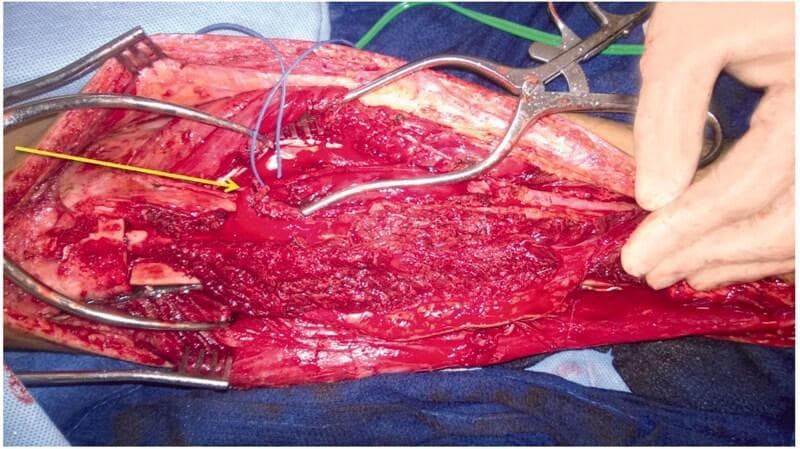 This clinical photograph captures an intra-operative view of a complex tibial reconstruction procedure. The surgical field displays a combination of a fresh-frozen hemi-tibia allograft and a free microvascular fibular graft. The hemi-tibia allograft is positioned deep and fixed to the proximal tibia with surgical plates and screws, providing structural support. Resting atop the allograft is the vascularized fibular graft, which is characterized by its reddish tissue texture. A yellow arrow points to the peroneal vascular pedicle of the fibular graft, showing unconnected vascular structures prepared for microvascular anastomosis. Multiple surgical instruments, including self-retaining retractors and clamps, are visible securing the muscle and soft tissue margins to maintain exposure. This composite grafting technique is typical for managing large segmental bone defects following radical resection of primary bone tumors, such as adamantinoma. The image illustrates the critical spatial relationship between structural allograft support and biological vascularized bone for optimal healing and hypertrophy.