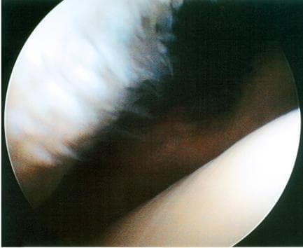 This diagnostic image is an intraoperative arthroscopic photograph of the patellofemoral joint within the human knee. The visual demonstrates the articular surfaces of the patella and the femur. On the left side of the frame, the patellar articular cartilage exhibits a Grade II chondral lesion characterized by visible surface irregularities, a frayed or 'shaggy' texture, and non-uniform coloration, consistent with chondromalacia. Despite these superficial changes, the lesion does not penetrate to the depth of the subchondral bone. In contrast, the femoral trochlear surface on the right appears smooth, white, and intact with a healthy glistening quality. This image is a classic educational example used in orthopedics to distinguish between pathological cartilage softening or fibrillation and normal hyaline cartilage. It serves as a clinical reference for the arthroscopic classification of chondral damage in the context of anterior knee pain or patellofemoral osteoarthritis.