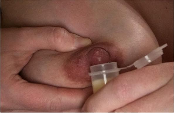 A close-up clinical photograph demonstrating the Marmet technique for hand-expressing antenatal milk or colostrum. The image shows a person's hands positioned on a lactating breast. One hand supports the breast tissue, with the thumb and index finger placed approximately 2-3 cm behind the nipple at the edge of the areola, applying rhythmic compression to the underlying milk ducts. The areola appears physiologically hyperpigmented and slightly engorged, typical of late pregnancy or the early postpartum period. A small, clear, flip-top collection vial is held directly beneath the nipple to capture the expressed fluid. The vial contains a small volume of yellowish, viscous fluid, characteristic of colostrum. This visual serves as an educational guide for lactation support, specifically teaching manual expression and collection techniques for individuals in the late third trimester (antenatal milk expression) or early postpartum phase.