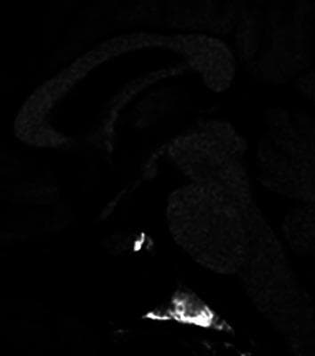This diagnostic image is a contrast-enhanced MRI of the brain, specifically focusing on a sagittal view of the sellar and suprasellar regions. The image demonstrates the pituitary gland situated within the sella turcica. A key finding is the heterogeneous enhancement of the pituitary parenchyma, characterized by non-uniform signal intensity following intravenous contrast administration. Instead of the typical homogeneous bright signal, the gland shows patchy areas of varying brightness and relative hypoenhancement. The overall morphology of the gland appears slightly enlarged or distorted with poorly defined margins in certain sections. This visual pattern is a significant clinical indicator of hypophysitis, potentially secondary to immune checkpoint inhibitor (ICI) therapy. The image serves as an educational example of how inflammatory processes can alter the vascular and structural integrity of the pituitary gland, leading to abnormal contrast uptake patterns compared to normal glandular tissue.