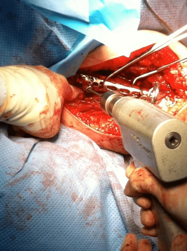 This intra-operative clinical photograph captures a surgical procedure for proximal humeral fracture fixation. The image demonstrates the placement of a PHILOS (Proximal Humeral Interlocking System) plate onto the humerus via a deltopectoral approach. A metallic, multi-hole anatomical locking plate is positioned against the bone, and a surgical power drill is seen in the foreground, perpendicular to the plate, engaged in drilling or screw insertion. Retractors are utilized to maintain visualization of the surgical field, which shows exposed muscle and bone tissue with some surgical hemorrhage. A surgeon's gloved hand is visible, stabilizing the area. The educational focus is on the orthopedic technique of internal fixation and the intra-operative application of locking compression plates for complex humeral fractures.