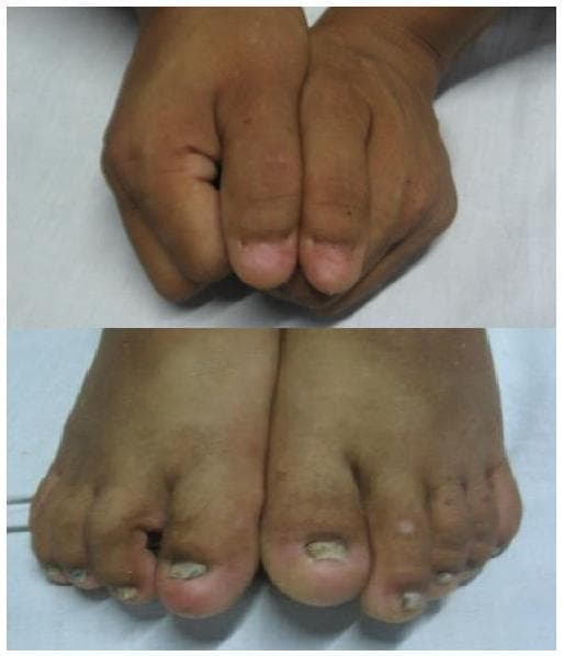 Clinical photograph showing nail dysplasia in the hands and feet, a characteristic finding of Nail-Patella Syndrome (NPS). The upper image displays the fingernails, which are hypoplastic and misshapen, appearing notably small and triangular, particularly on the thumbs. The lower image shows the toenails, which exhibit more severe onychodystrophy. The toenails are markedly reduced in size, thickened, and demonstrate significant leuconychia (opaque white discoloration) and surface irregularities, including pitting and longitudinal ridging. This visual presentation illustrates a key diagnostic feature of NPS, which often affects the nails of the hands more prominently than the feet, with the radial side (thumbs) typically being most severely involved. These clinical signs are often associated with other systemic features of the syndrome, such as patellar hypoplasia, iliac horns, and progressive renal disease.