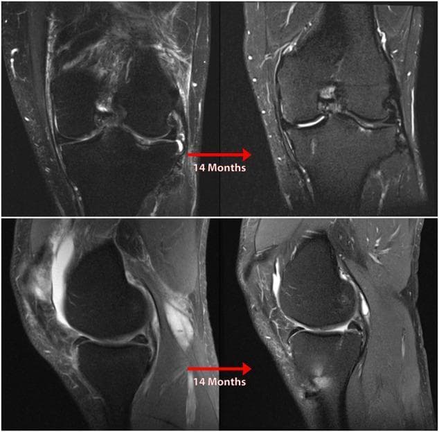 Diagnostic Magnetic Resonance Imaging (MRI) comparison demonstrating the 14-month progression of medial compartment osteoarthritis in the left knee. The image set includes T2-weighted fluid-sensitive sequences in both coronal (top) and sagittal (bottom) planes. Key visual features include significant joint space narrowing in the medial compartment and the development of high-signal subchondral bone marrow lesions (edema) in the medial femoral condyle and medial tibial plateau. The sagittal views highlight progressive meniscal extrusion and morphological changes following a nonanatomic posterior medial meniscus root repair. There is evidence of increasing subchondral sclerosis, osteophyte formation, and joint effusion over the 14-month interval. This comparison serves as a clinical illustration of rapid degenerative joint disease secondary to altered knee biomechanics and meniscus root insufficiency. The material is intended for orthopedic and radiological education focusing on meniscal pathology and its role in joint preservation.