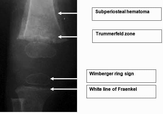 This diagnostic x-ray radiograph illustrates the classic skeletal manifestations of pediatric scurvy (vitamin C deficiency) in a long bone. The image is annotated to highlight several pathognomonic radiological signs: 1) The 'White Line of Fraenkel,' a dense, thickened zone of provisional calcification at the metaphysis; 2) The 'Trummerfeld zone,' a radiolucent scorbutic band located immediately proximal to the white line, representing a zone of rarefaction where bone formation is suppressed; 3) 'Wimberger ring sign,' characterized by a thin sclerotic rim surrounding a lucent center in the epiphysis; and 4) signs of a subperiosteal hematoma, visible as periosteal elevation along the diaphysis. These findings are critical diagnostic markers in pediatric radiology for metabolic bone disease and nutritional deficiencies. The educational focus is on identifying metaphysis and epiphysis abnormalities related to defective collagen synthesis and osteoblast function.