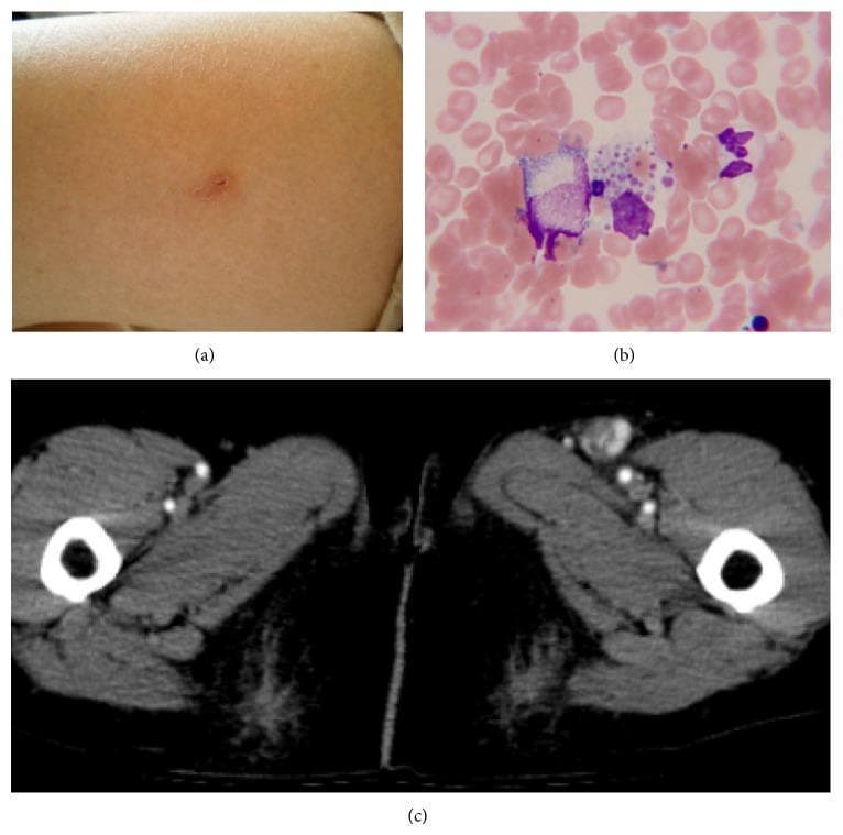 A composite of three images documenting a case of Severe Fever with Thrombocytopenia Syndrome Virus (SFTSV) infection. (a) Clinical photograph of the lateral left thigh showing a small, focal tick bite site, characterized by a minor cutaneous puncture with localized mild erythema and no surrounding rash or wheal. (b) Light microscopy of a Giemsa-stained bone marrow aspirate demonstrating hemophagocytosis; specifically, a large macrophage containing engulfed platelet-specific material, characteristic of the hematologic complications of SFTSV. (c) Axial contrast-enhanced computed tomography (CT) scan of the pelvic/inguinal region revealing significant unilateral left inguinal lymphadenopathy. The enlarged lymph node shows contrast enhancement compared to surrounding soft tissue. These panels collectively illustrate the primary inoculation site, systemic hematologic response, and localized lymphatic involvement in a viral zoonotic infection.