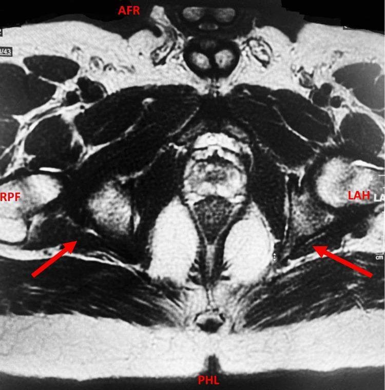 This diagnostic image is an axial MRI scan of the male pelvis, specifically a dedicated fistula protocol study with intravenous contrast. The image highlights the perianal region and pelvic floor anatomy. Anatomical landmarks include the gluteal muscles, pelvic bones, and the anal canal. Red arrows indicate bilateral, hyperintense linear tracts representing intersphincteric perianal fistulas. These tracts are situated within the intersphincteric space between the internal and external anal sphincters, with internal openings visualized at approximately the 5 o'clock and 7 o'clock positions. The rectum and sigmoid colon show evidence of mild circumferential wall thickening, suggesting an underlying inflammatory process. The surrounding soft tissues show subtle signal changes consistent with inflammation but lack evidence of complex trans-sphincteric extension, supralevator involvement, or localized abscess formation. This imaging is clinically significant for the classification of perianal Crohn's disease or chronic inflammatory conditions like Schistosomiasis-related granulomatous colitis, facilitating surgical planning and disease staging.