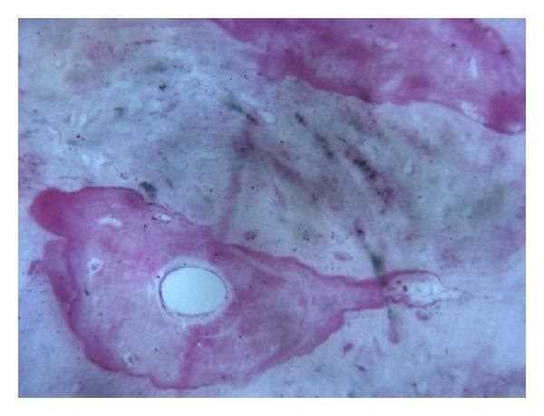 This histological diagnostic image, captured at 200x magnification, demonstrates the integration of grafted bone and newly formed bone tissue in a human mandibular model. The section is stained with acid fuchsin-toluidine blue, which highlights the structural components of the bone matrix. A prominent feature is an osteon, visible as a roughly circular, organized structure in the lower-left quadrant. This osteon exhibits a central, unstained Haversian canal surrounded by concentric lamellae and a more intensely pink-stained periphery (cement line). The surrounding regions show a mixture of intensely stained pink and purple areas representing high-affinity newly formed bone, contrasting with lighter, whitish or light-blue areas indicating mature or grafted bone matrix. The image illustrates the process of bone remodeling and osseointegration following a bone augmentation procedure, demonstrating the close contact between the graft material and the regenerated bone without interposing fibrous tissue. Small, dark dots represent osteocyte lacunae distributed throughout the matrix.